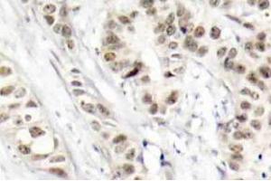 Immunohistochemistry (IHC) analysis of p-BRCA1 (pSer1524) pAb in paraffin-embedded human breast carcinoma tissue. (BRCA1 antibody  (pSer1524))