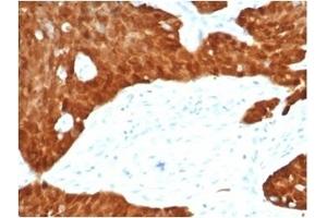 Formalin-fixed, paraffin-embedded human ovarian carcinoma stained with P16INK4a Recombinant Rabbit Monoclonal Antibody (CDKN2A/7081R). (Recombinant CDKN2A antibody)