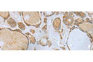 Immunohistochemistry of paraffin-embedded Human thyroid cancer tissue using ENKD1 Polyclonal Antibody at dilution of 1:80(x200) (ENKD1 antibody)