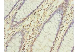 Immunohistochemistry of paraffin-embedded human colon cancer using ABIN7150545 at dilution of 1:100 (DNAJC17 antibody  (AA 1-304))