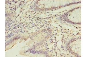 Immunohistochemistry of paraffin-embedded human colon cancer using ABIN7152867 at dilution of 1:100 (FGL2 antibody  (AA 24-439))