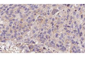 ABIN6273207 at 1/100 staining Human melanoma tissue by IHC-P. (CFHR3 antibody)