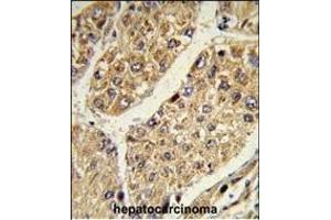 Formalin-fixed and paraffin-embedded human hepatocarcinoma reacted with CSGALNACT2 Antibody (Center), which was peroxidase-conjugated to the secondary antibody, followed by DAB staining. (CSGALNACT2 antibody  (AA 200-229))