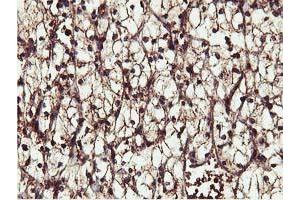 Immunohistochemical staining of paraffin-embedded Carcinoma of Human kidney tissue using anti-IDS mouse monoclonal antibody. (IDS antibody)