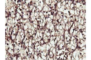 Immunohistochemical staining of paraffin-embedded Carcinoma of Human kidney tissue using anti-IDS mouse monoclonal antibody.