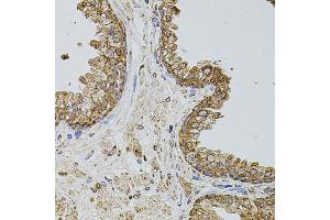 Immunohistochemistry of paraffin-embedded human prostate using SELP antibody (ABIN5974707) at dilution of 1/100 (40x lens). (P-Selectin antibody)