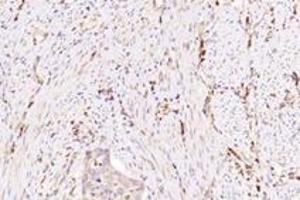Immunohistochemistry analysis of paraffin-embedded human cervical cancer using NXF2 (ABIN7074901) at dilution of 1: 3000 (NXF2 antibody)