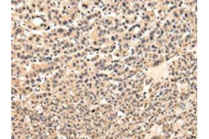 The image on the left is immunohistochemistry of paraffin-embedded Human liver cancer tissue using ABIN7131585(VPS37D Antibody) at dilution 1/30, on the right is treated with fusion protein. (VPS37D antibody)