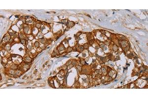 Immunohistochemistry of paraffin-embedded Human breast cancer tissue using MTUS1 Polyclonal Antibody at dilution 1:40 (MTUS1 antibody)
