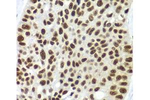 Immunohistochemistry of paraffin-embedded Human lung cancer using SF3B2 Polyclonal Antibody at dilution of 1:100 (40x lens). (SF3B2 antibody)
