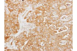 IHC-P Image Immunohistochemical analysis of paraffin-embedded human colon carcinoma, using Tuftelin 1, antibody at 1:250 dilution. (TUFT1 antibody)