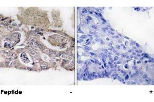 Immunohistochemical analysis of paraffin-embedded human colon carcinoma tissue using MARK2 polyclonal antibody .