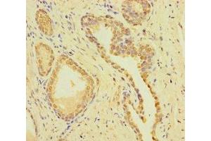 Immunohistochemistry of paraffin-embedded human prostate cancer using ABIN7148722 at dilution of 1:100
