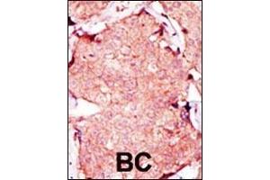 Formalin-fixed and paraffin-embedded human cancer tissue reacted with the primary antibody, which was peroxidase-conjugated to the secondary antibody, followed by AEC staining. (Adenylate Kinase 3 antibody  (C-Term))