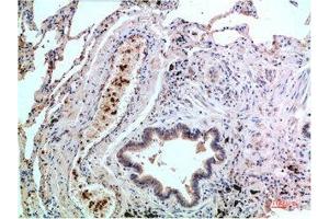 Immunohistochemical analysis of paraffin-embedded Human Lung Carcinoma Tissue using P38 Mouse mAb diluted at 1:200. (MAPK14 antibody)