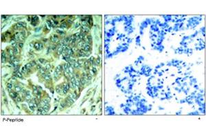 Immunohistochemical analysis of paraffin-embedded human breast carcinoma tissue using DOK1 (phospho Y398) polyclonal antibody . (DOK1 antibody  (pTyr398))