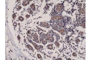 Immunohistochemical staining (Formalin-fixed paraffin-embedded sections) of human breast cancer with DIABLO monoclonal antibody, clone RM271 . (DIABLO antibody  (C-Term))