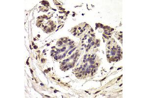Immunohistochemistry of paraffin-embedded Human mammary cancer using INTS6 antibody at dilution of 1:100 (x400 lens). (INTS6 antibody)