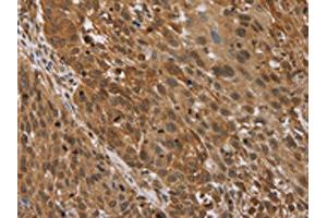 The image on the left is immunohistochemistry of paraffin-embedded Human lung cancer tissue using ABIN7192693(STMN2/STMN3/STMN4 Antibody) at dilution 1/45, on the right is treated with synthetic peptide. (STMN2/STMN3/STMN4 antibody)