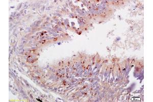 Formalin-fixed and paraffin embedded human lung carcinoma labeled with Anti-TBX2/T-box2 Polyclonal Antibody, Unconjugated (ABIN669441) at 1:200 followed by conjugation to the secondary antibody and DAB staining. (TBX2 antibody  (AA 401-500))