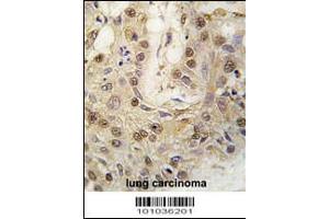 Formalin-fixed and paraffin-embedded human lung carcinoma tissue reacted with cGKII antibody , which was peroxidase-conjugated to the secondary antibody, followed by DAB staining.