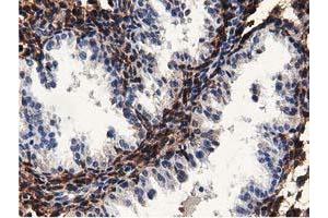 Immunohistochemical staining of paraffin-embedded Carcinoma of Human kidney tissue using anti-MICAL1 mouse monoclonal antibody.