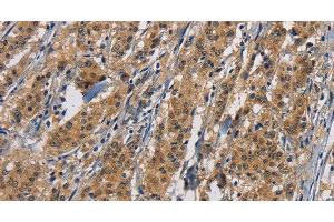 Immunohistochemistry of paraffin-embedded Human gastric cancer tissue using PIKFYVE Polyclonal Antibody at dilution 1:50 (PIKFYVE antibody)