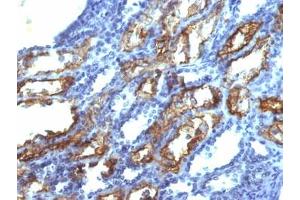 IHC testing of FFPE human renal cell carcinoma with IFN gamma antibody (clone IFNG/466). (Interferon gamma antibody)