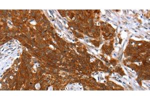Immunohistochemistry of paraffin-embedded Human cervical cancer tissue using HOXB1 Polyclonal Antibody at dilution 1:40 (HOXB1 antibody)