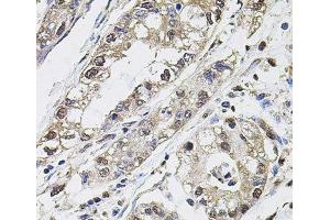 Immunohistochemistry of paraffin-embedded Human gastric cancer using CA9 Polyclonal Antibody at dilution of 1:100 (40x lens). (CA9 antibody)