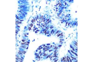 Immunohistochemistry of paraffin-embedded human colon carcinoma using USP7/HAUSP Rabbit mAb (ABIN7271168) at dilution of 1:100 (40x lens). (USP7 antibody)