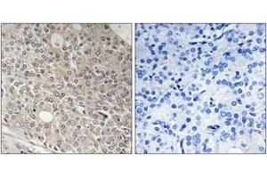 Immunohistochemistry analysis of paraffin-embedded human prostate carcinoma tissue, using AMOTL1 Antibody. (AMOTL1 antibody  (AA 441-490))
