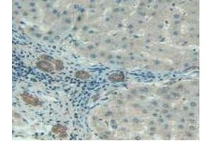 Detection of C1INH in Human Liver Cancer Tissue using Polyclonal Antibody to Complement 1 Inhibitor (C1INH) (SERPING1 antibody  (AA 399-500))
