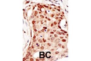 Formalin-fixed and paraffin-embedded human cancer tissue reacted with the primary antibody, which was peroxidase-conjugated to the secondary antibody, followed by DAB staining. (CBLC antibody  (C-Term))