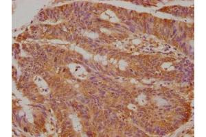 Immunohistochemical of paraffin-embedded human colon cancer using ABIN7173328 at dilution of 1:50 (TFF3 antibody)