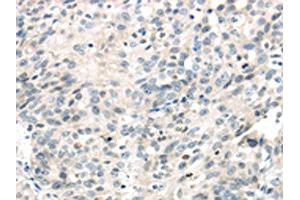 The image on the left is immunohistochemistry of paraffin-embedded Human ovarian cancer tissue using ABIN7191116(IQGAP2 Antibody) at dilution 1/40, on the right is treated with synthetic peptide. (IQGAP2 antibody)