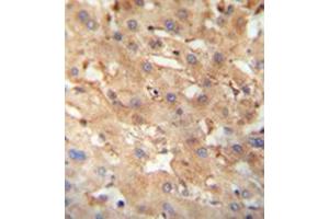 Immunohistochemistry analysis in formalin fixed and paraffin embedded human hepatocarcinoma reacted with NEU4 Antibody (C-term) followed which was peroxidase conjugated to the secondary antibody and followed by DAB staining. (Sialidase 4 antibody  (C-Term))