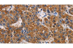 Immunohistochemistry of paraffin-embedded Human liver cancer tissue using APLNR Polyclonal Antibody at dilution 1:50 (Apelin Receptor antibody)