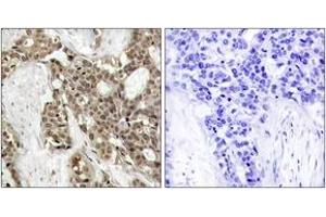 Immunohistochemistry analysis of paraffin-embedded human breast carcinoma, using p44/42 MAP Kinase (Phospho-Tyr204) Antibody. (ERK1/2 antibody  (pTyr204))