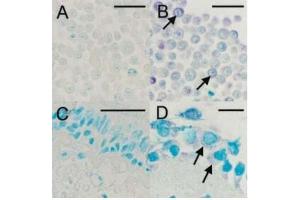IHC staining for viral capsid protein with ABIN1000236: (A) Uninfected HeLa cells, (B) HRV16-infected HeLa cells, (C) Negative bronchial biopsy section, (D) Positive bronchial biopsy section. (Rhinovirus 16 antibody)
