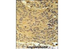LCLT1 Antibody (C-term) (ABIN651910 and ABIN2840449) immunohistochemistry analysis in formalin fixed and paraffin embedded human lung carcinoma followed by peroxidase conjugation of the secondary antibody and DAB staining. (LCLAT1 antibody  (AA 296-324))