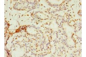 Immunohistochemistry of paraffin-embedded human breast cancer using ABIN7142992 at dilution of 1:100 (SMPDL3A antibody  (AA 51-350))