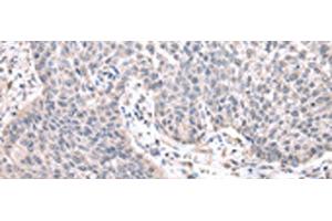 Immunohistochemistry of paraffin-embedded Human lung cancer tissue using ZNF239 Polyclonal Antibody at dilution of 1:25(x200) (ZNF239 antibody)