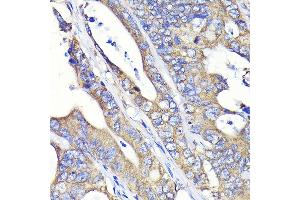 Immunohistochemistry of paraffin-embedded human colon carcinoma using Fatty Acid Synthase (FASN) Rabbit mAb  at dilution of 1:100 (40x lens). (Fatty Acid Synthase antibody)