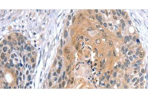 Immunohistochemistry of paraffin-embedded Human esophagus cancer using GNAT3 Polyclonal Antibody at dilution of 1:35 (GNAT3 antibody)