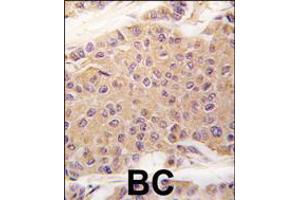 Formalin-fixed and paraffin-embedded human breast carcinoma tissue reacted with TGFB2 antibody , which was peroxidase-conjugated to the secondary antibody, followed by DAB staining.