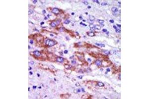 Formalin-fixed and paraffin-embedded human cancer tissue reacted with the primary antibody, which was peroxidase-conjugated to the secondary antibody, followed by DAB staining. (Casein Kinase 1 delta antibody  (C-Term))