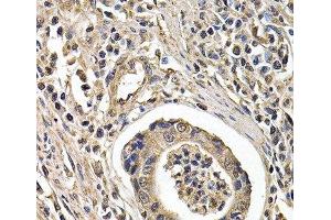 Immunohistochemistry of paraffin-embedded Human gastric cancer using ARRB2 Polyclonal Antibody at dilution of 1:200 (40x lens). (Arrestin 3 antibody)