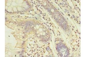 Immunohistochemistry of paraffin-embedded human colon cancer using ABIN7143952 at dilution of 1:100