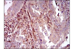Immunohistochemical analysis of paraffin-embedded endometrial cancer tissues using MAPK14 mouse mAb with DAB staining. (MAPK14 antibody  (AA 299-360))